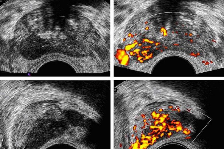 diagnostic du cancer de la prostate