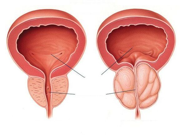 prostate saine et malade